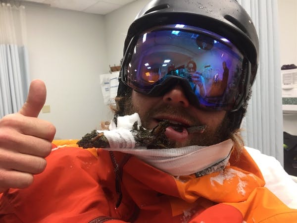 Skier takes stick to the face