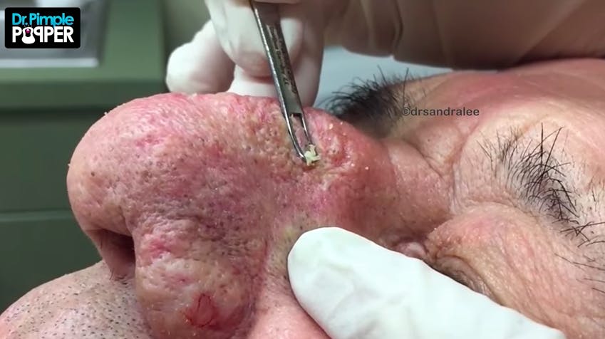 best pimple popping videos