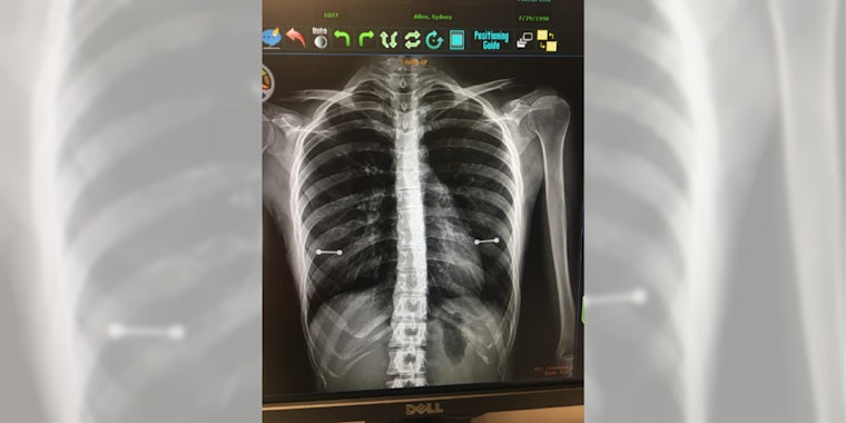 A teen says her mom discovered her nipple piercings from an X-ray.