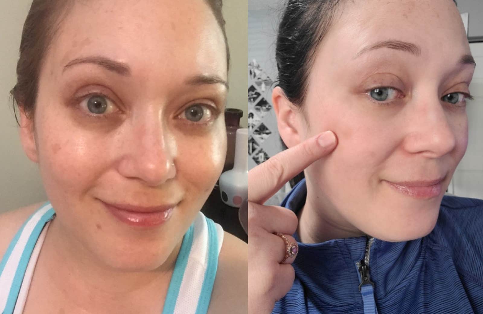 This New Vitamin C Treatment Erases Sun Damage Fast