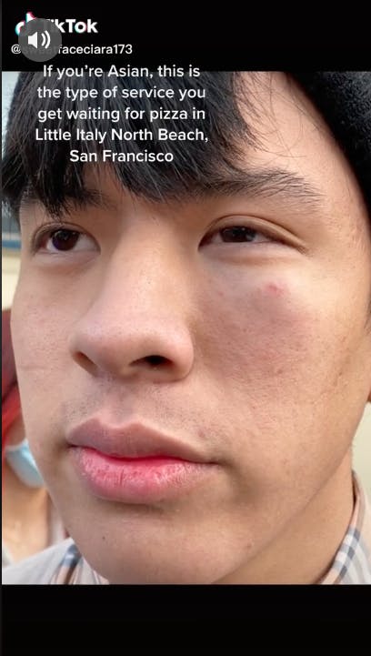 Asian 18-year-old with swollen and bruised eye