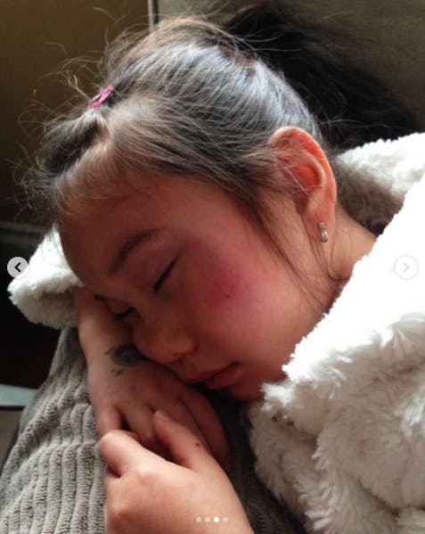 lil tay with bruised face