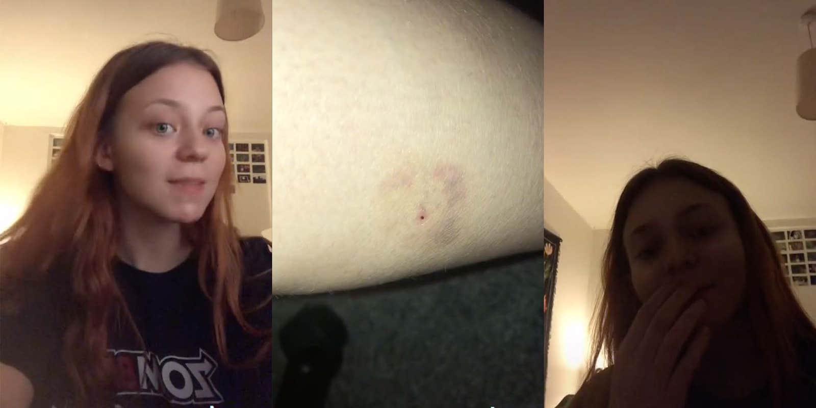 TikToker Says She May Have Been 'Injection Spiked' During Night Out