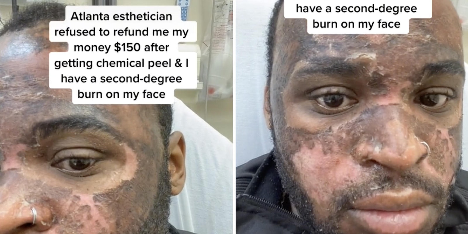 man with burns on his face