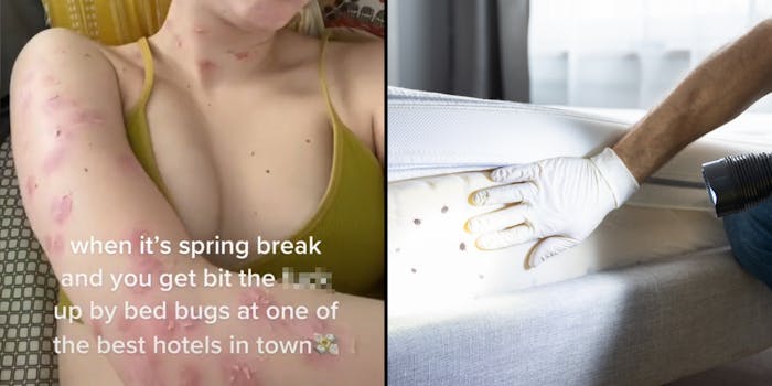 Women chest and arm covered in bites caption "when it's spring break and you get bit the blank up by bed bugs at one of the best hotels in town" (l) Man with flashlight looking at bedbugs on mattress (r)