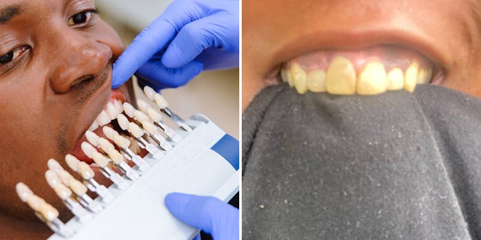 dentist holding teeth color swatches up to male patients mouth (l) person shirt in mouth teeth exposed veneers (r)