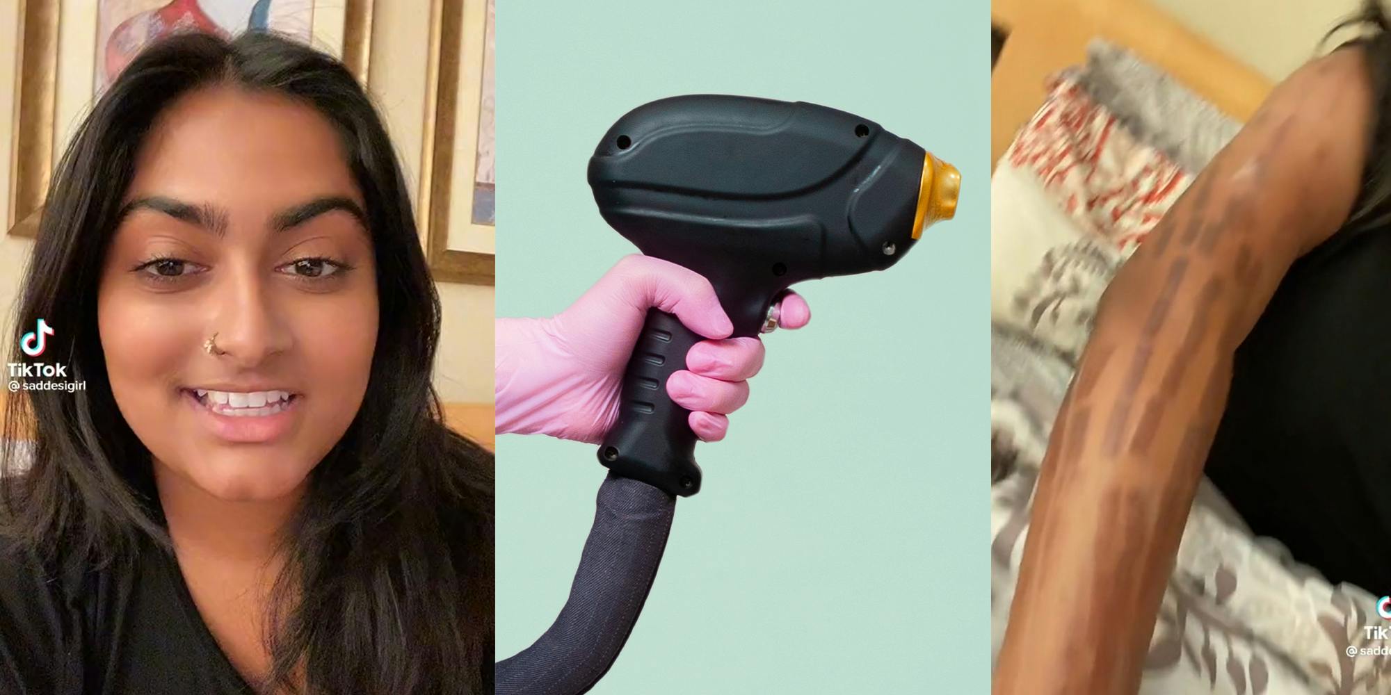 young woman (l) hand holding laser hair removal gun (c) arm with burn marks (r)