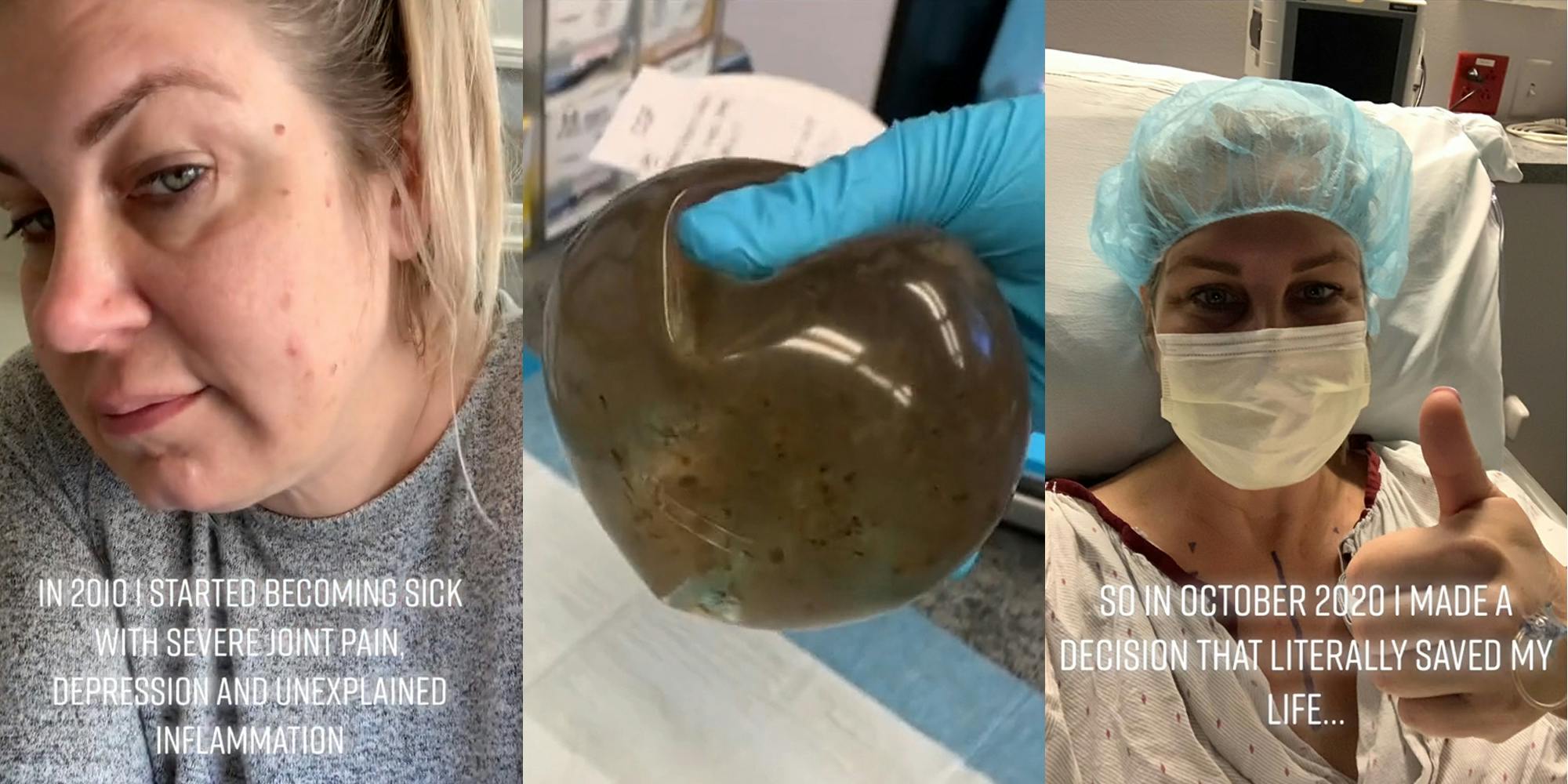 Woman Shares Her Experience With Breast Implant Illness