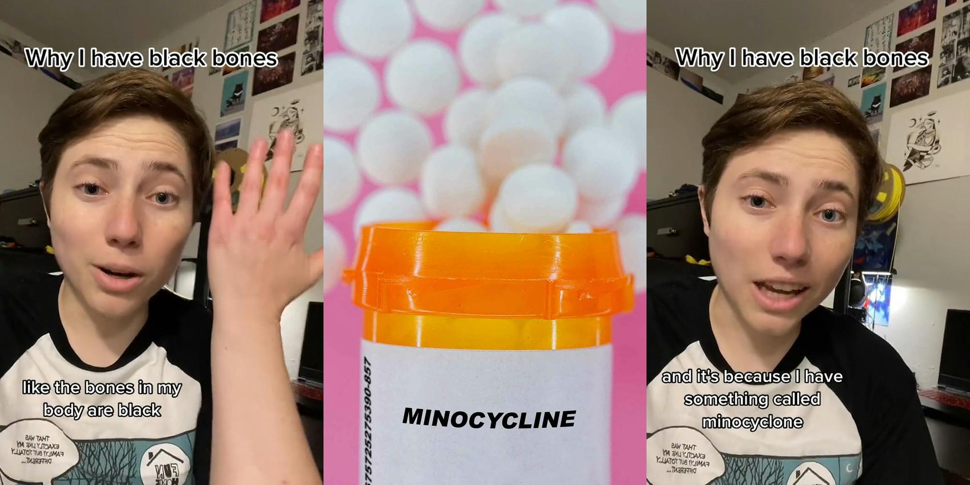 TikToker speaking with hand up caption "Why I have Black Bones" "like the bones in my body are black" (l) Minocycline pill bottle with blurred spilled pills on pink background (c) TikToker speaking with caption "Why I have Black Bones" "and it's because I have something called minocyclone" (r)