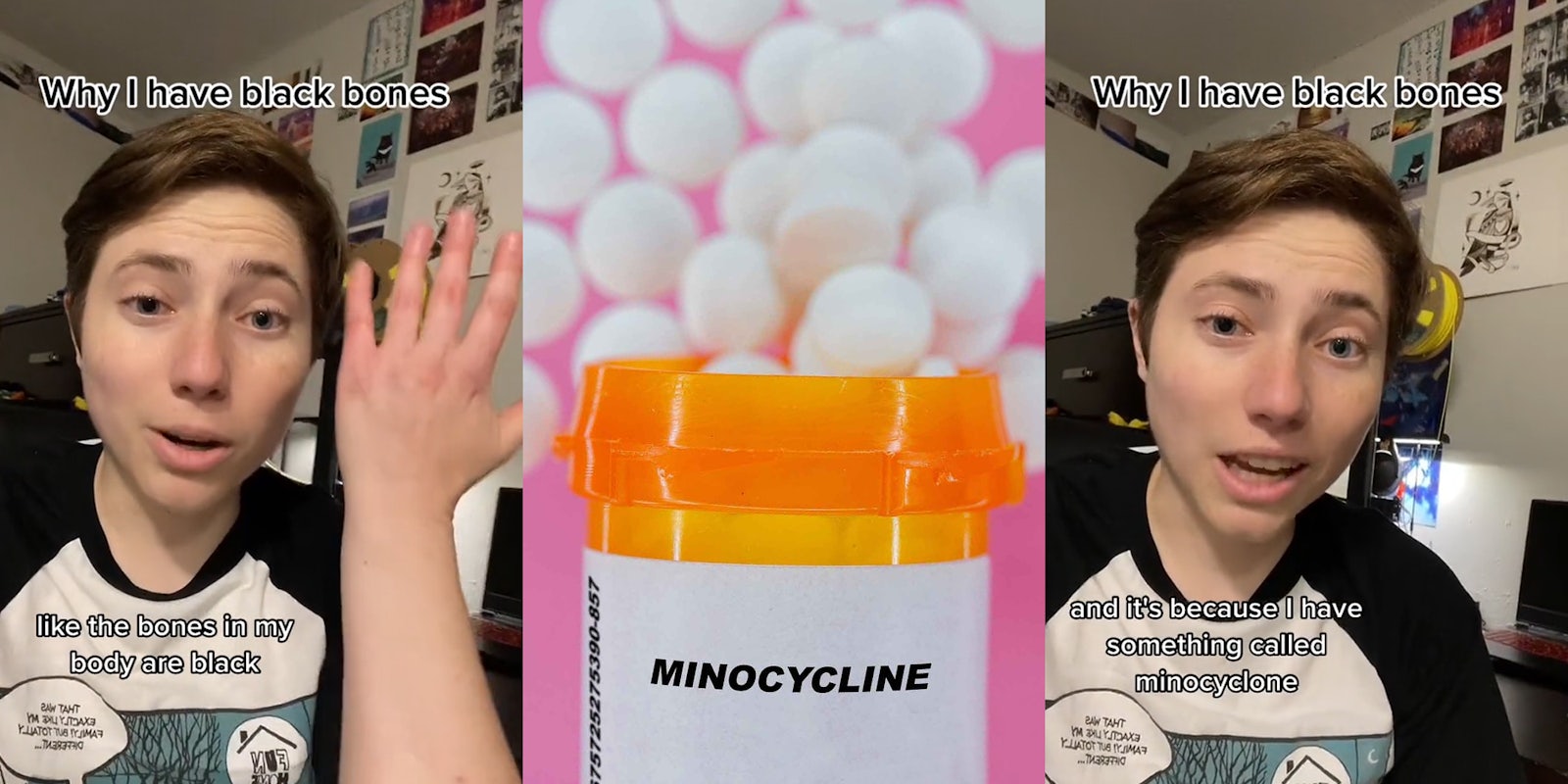TikToker speaking with hand up caption 'Why I have Black Bones' 'like the bones in my body are black' (l) Minocycline pill bottle with blurred spilled pills on pink background (c) TikToker speaking with caption 'Why I have Black Bones' 'and it's because I have something called minocyclone' (r)