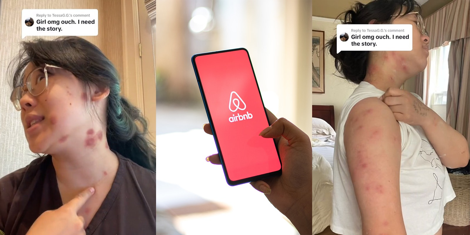 Photo of woman with bed bug bites all over her body and photo of woman holding phone with air bnb logo