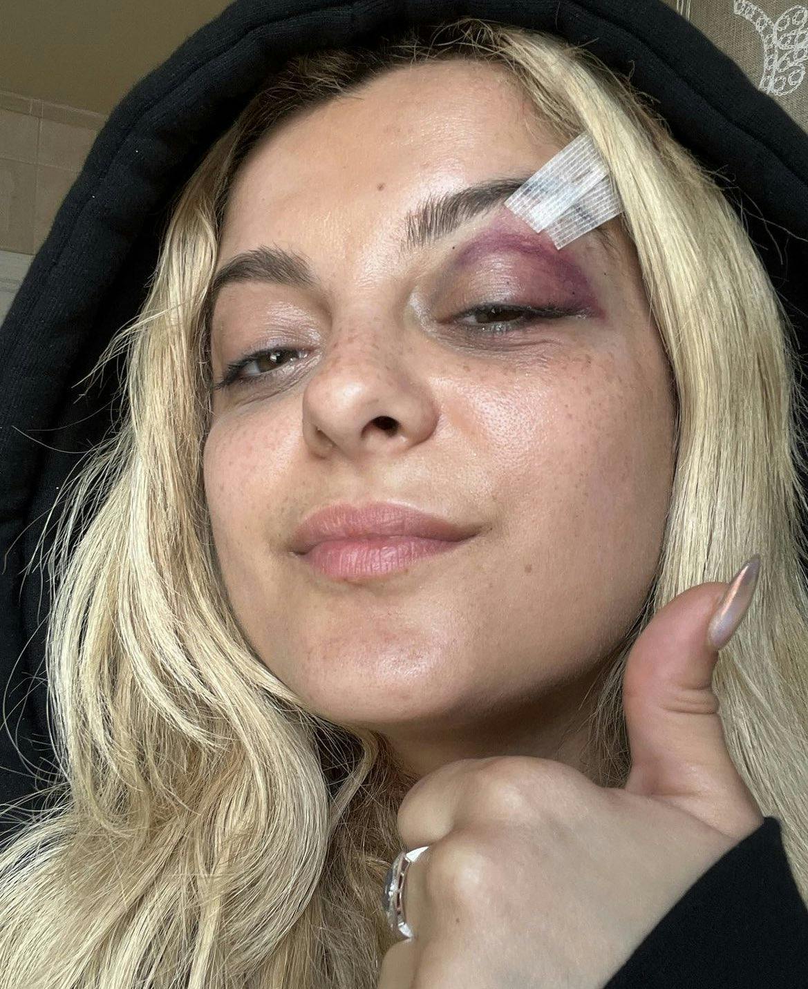bebe rexha showing a thumbs up and a bruised eye with stitches above the eyelid