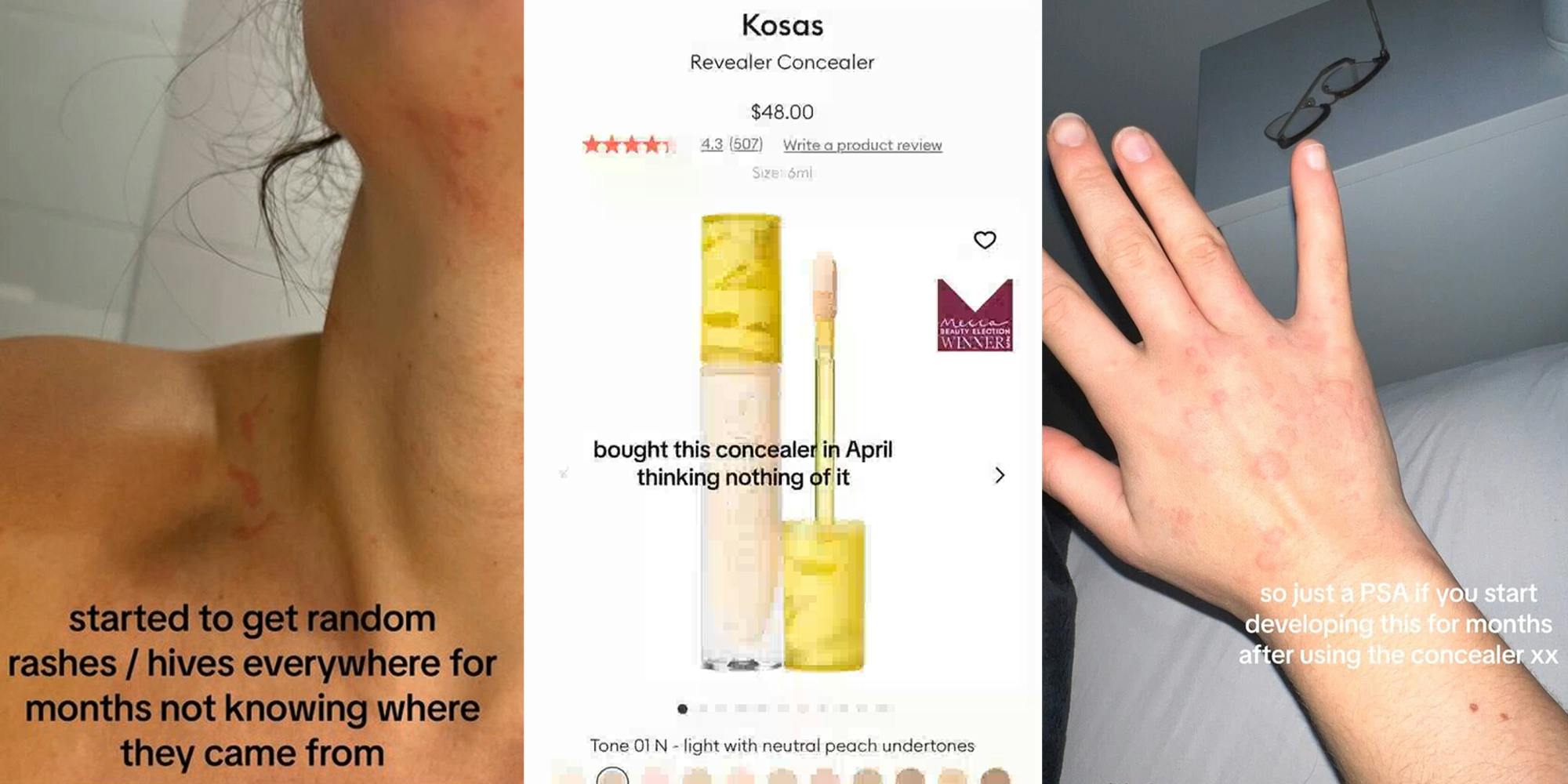 woman with rash with caption "started to get random rashes/hives everywhere for months not knowing where they came from" (l) Kosas concealer on website with caption "bought this concealer in April thinking nothing of it" (c) hand with rash with caption "so just a PSA if you start developing this for months after using concealer" (r)