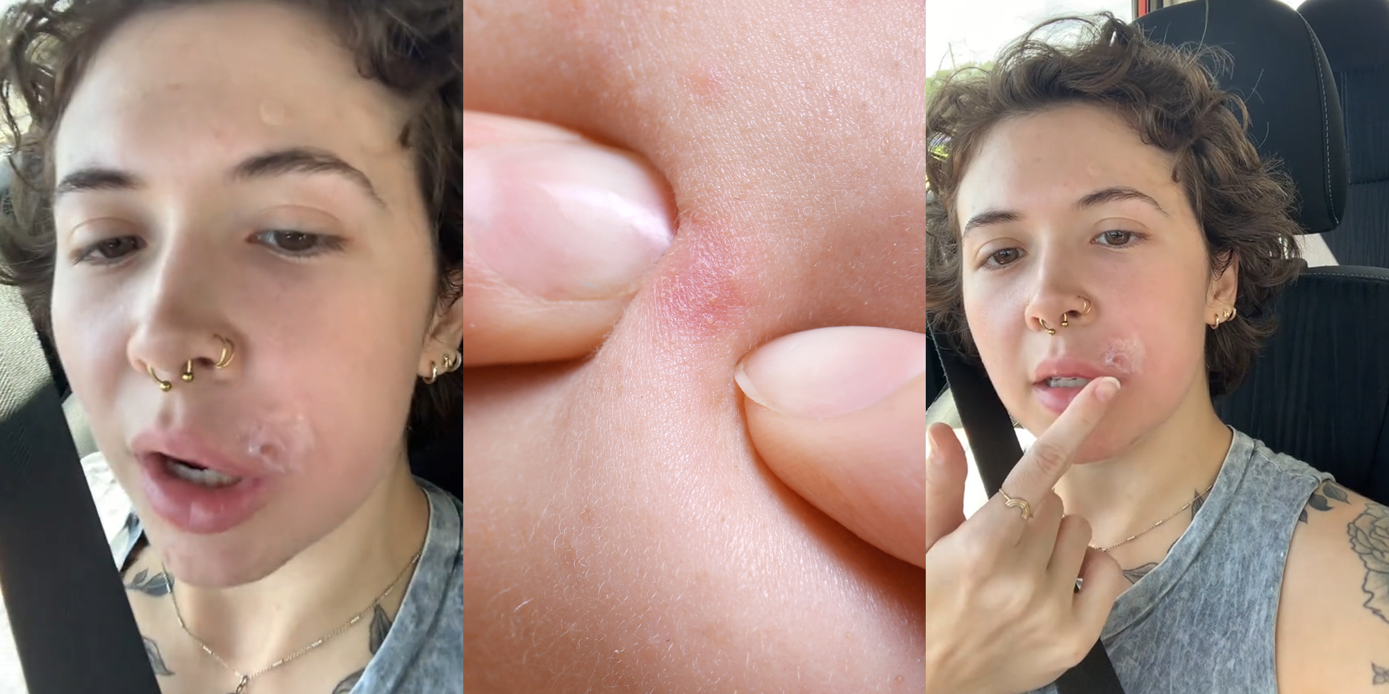 Popped pimple infected deals swollen