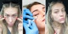 Woman warns against under eye filler, shares why she regrets it 2 years later