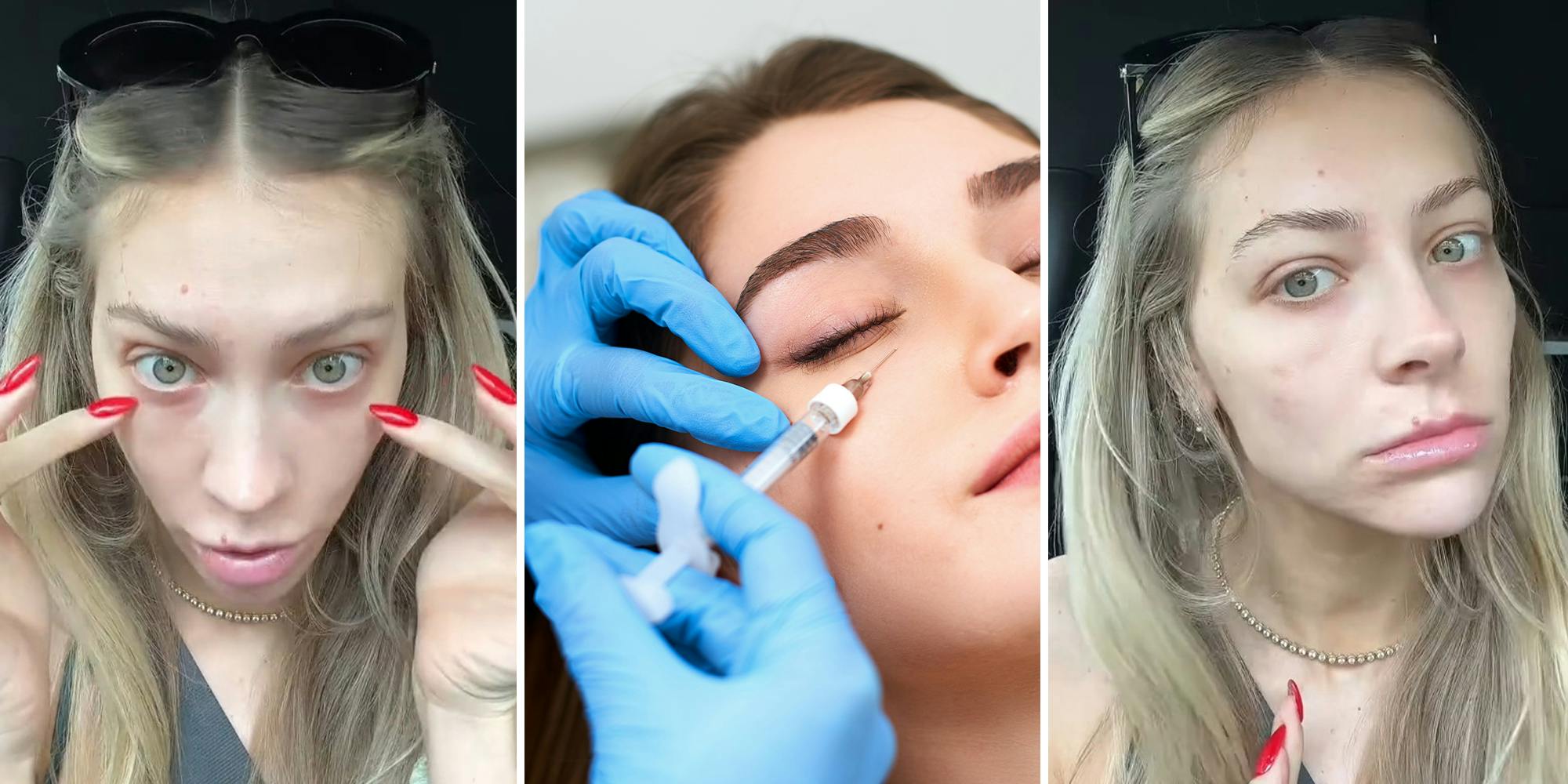 ‘I notice these 2 dimples’: Woman warns against under eye filler, shares why she regrets it 2 years later