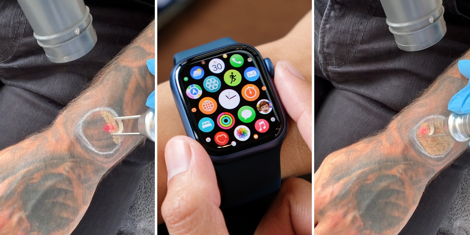 Man gets tattoo removed so Apple Watch can work properly