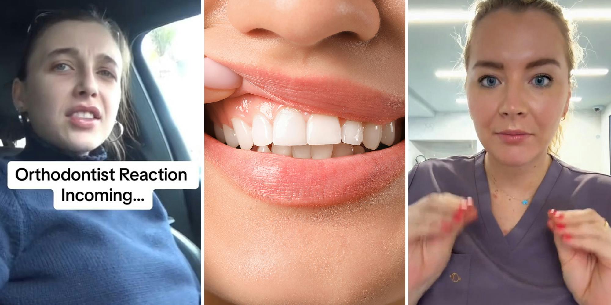 ‘This is your sign to stop’: Expert issues warning on how Zyn can affect your gums after Emma Chamberlain speaks out about dental problems