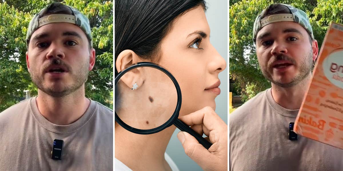 Can This Baking Soda Trick Get Rid Of Unwanted Moles Can this baking soda trick get rid of unwanted moles