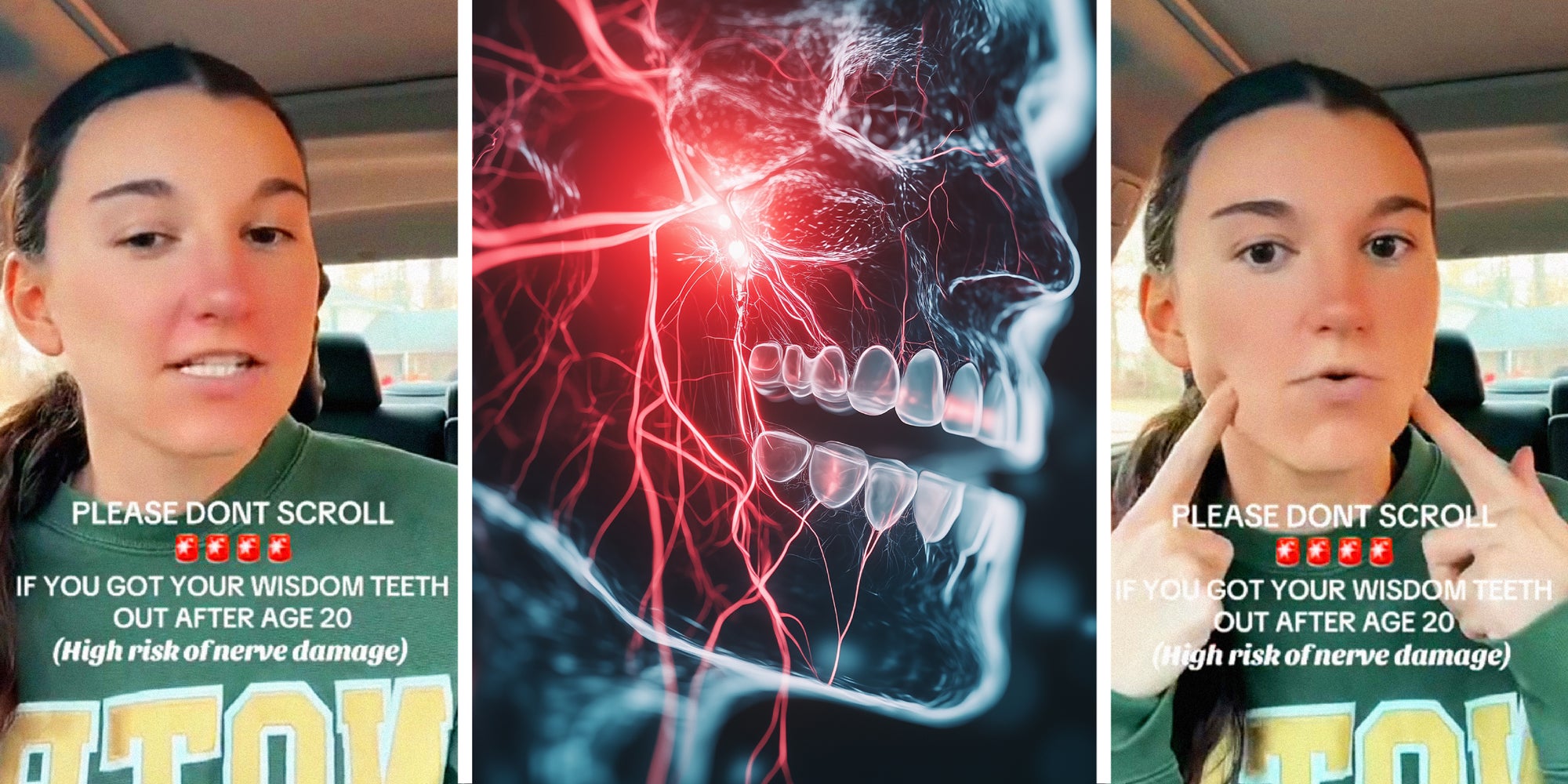 3 panel image: on the sides a person explains, in the middle is a AI generated cutaway of a human face with nerves glowing underneath. Text over says: PLEASE DONT SCROLL, IF YOU GOT YOUR WISDOM TEETH OUT AFTER AGE 20, (high risk of nerve damage).