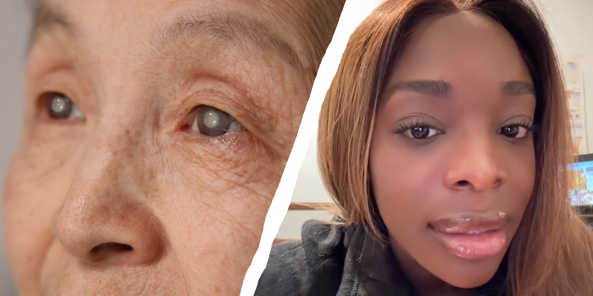 What Are Cataracts How Do You Avoid It Cataracts Everybody Gets Them