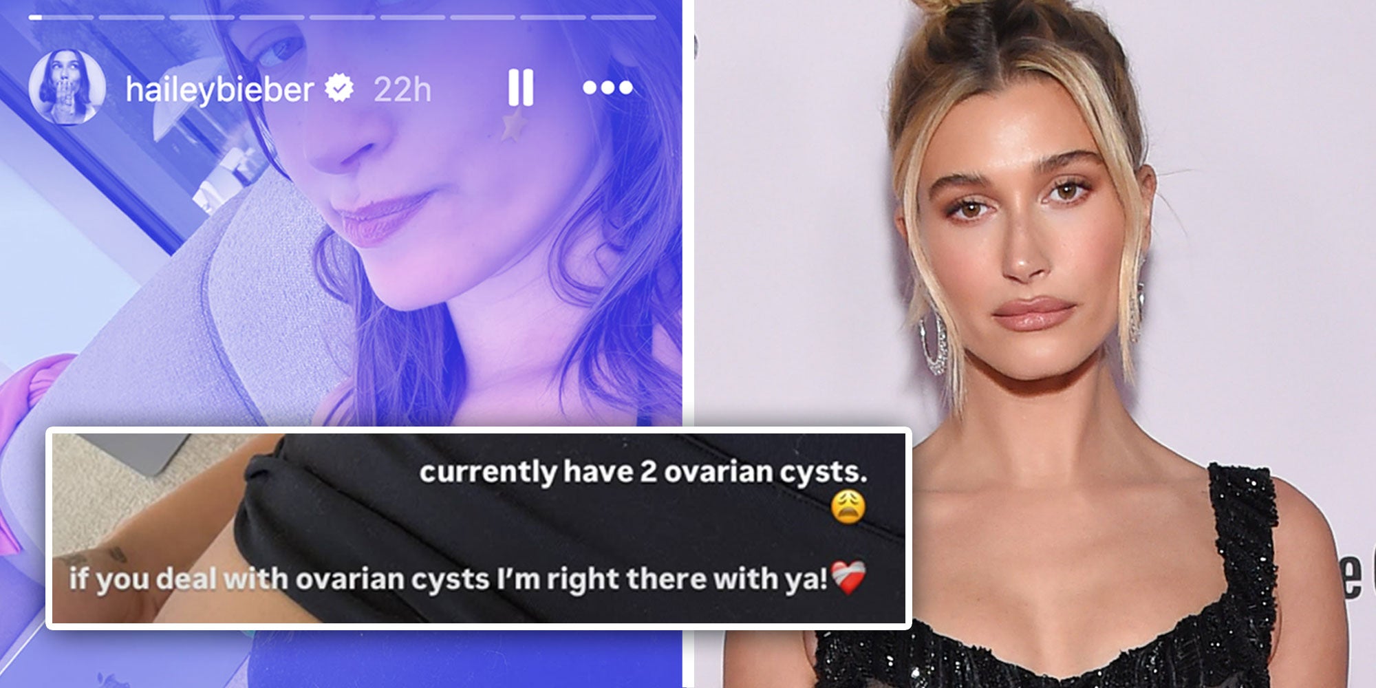 Left: Hailey Bieber from her Instagram story with the caption "currently have 2 ovarian cysts. if you deal with ovarian cysts I'm right there with ya!"