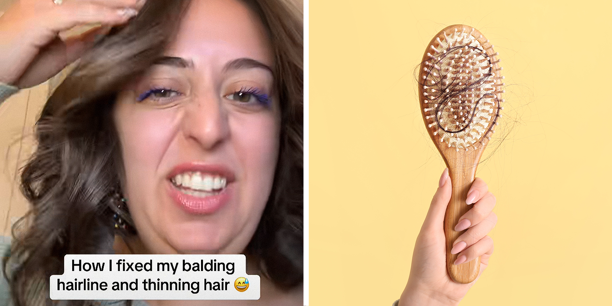 2 image split. Woman holding hair with caption that reads: 'How I fixed my balding hairline and thinning hair (sweaty emoji)' on left. Hair brush full of hair on right.