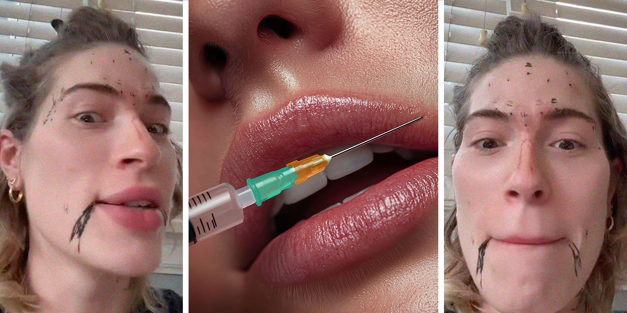 woman gives herself diy at home filler botox