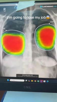 AI identifying pneumonia on a chest X-ray. Text overlay reads, "I'm going to lose my job (shocked face emoji)"
