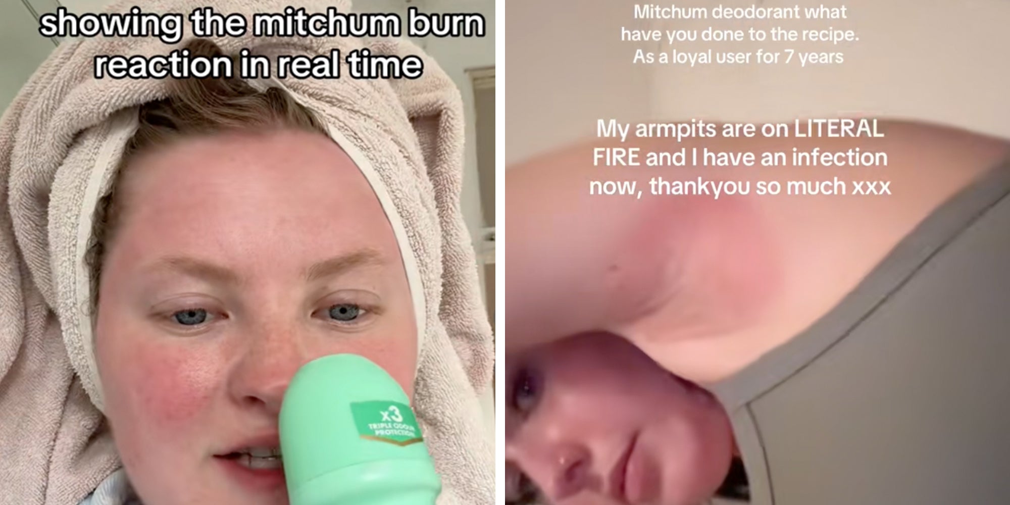 Left: Woman holding a green Mitchum deodorant, towel wrapped aroud her head. Text overlay reads, "Showing the Mitchum burn reaction in real time." Right: Woman showing bright red irritated armpit, text overlay reads, "Mitchum deodorant what have you done to the recipe. As a loyal user for 7 years my armpits are on LITERAL FIRE and I have an infection now."