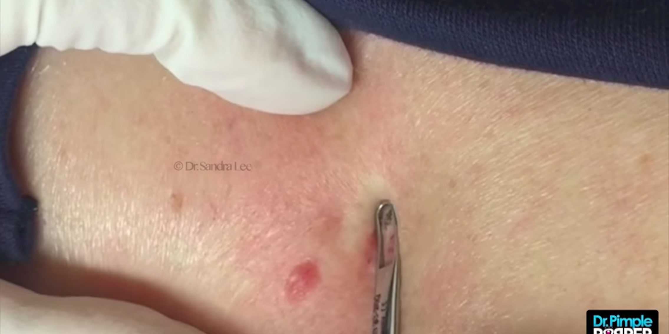 kreupel Diverse bewijs The 15 Best Pimple Popping Videos on YouTube