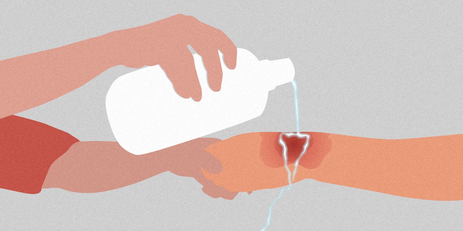 Apply cold water to that burn meme