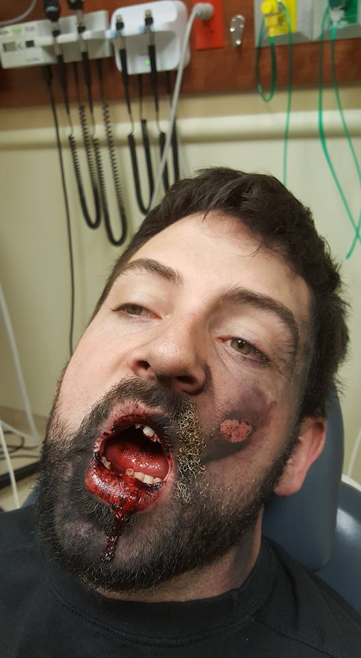 Man Shares Gruesome Photos After Vape Pen Allegedly Explodes In