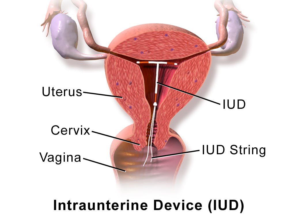 what is an iud