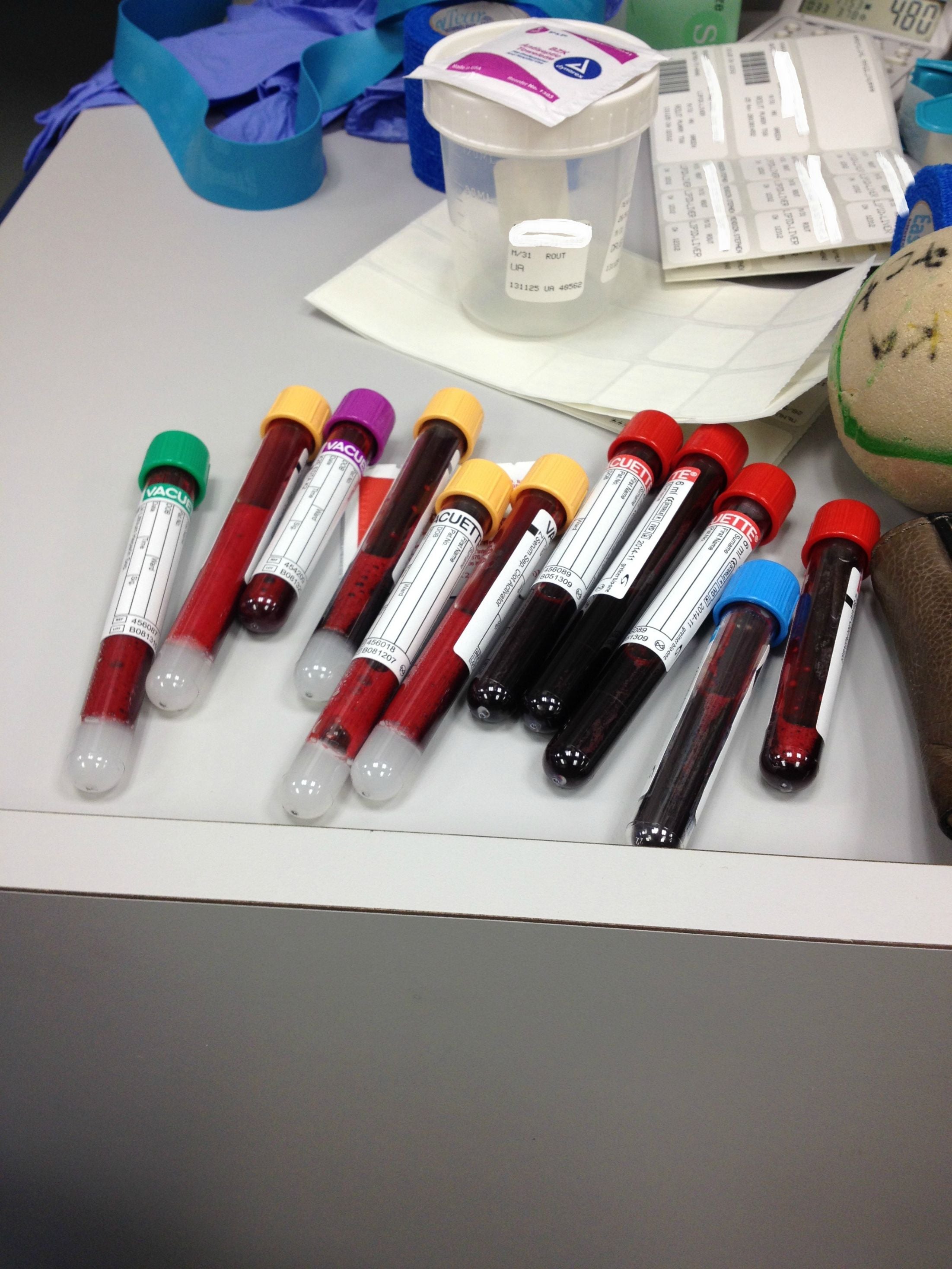 Patient in need of a kidney finds a living donor on Reddit