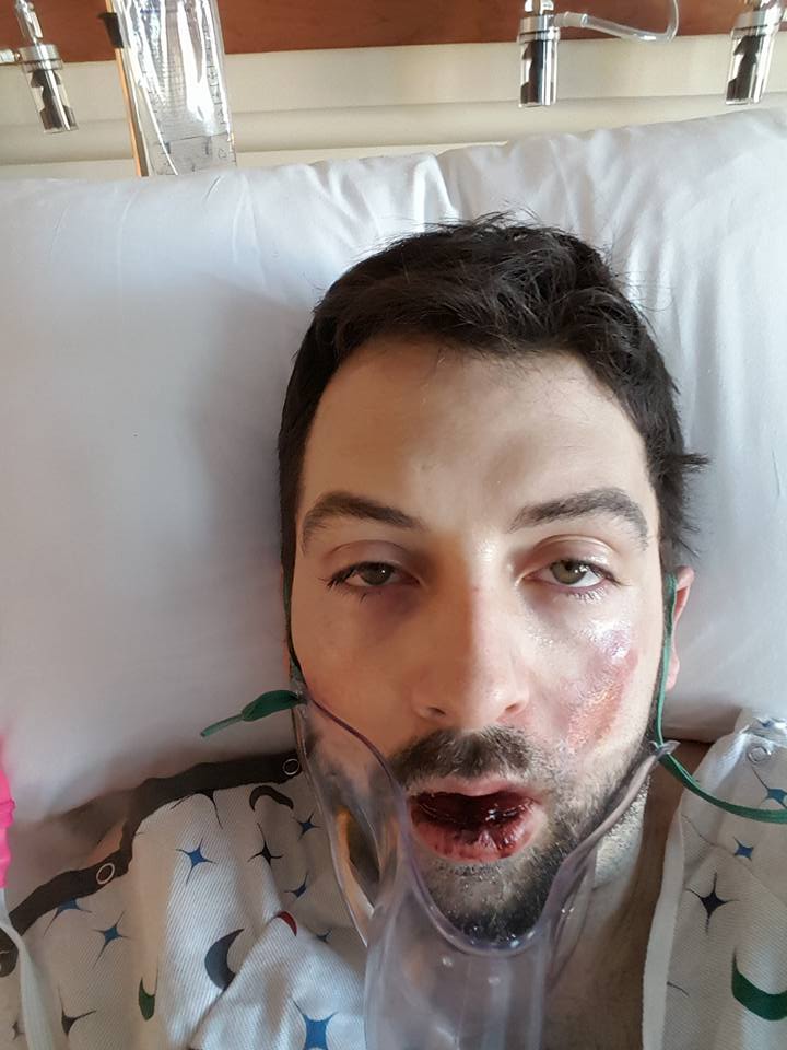 Man Shares Gruesome Photos After Vape Pen Allegedly Explodes In