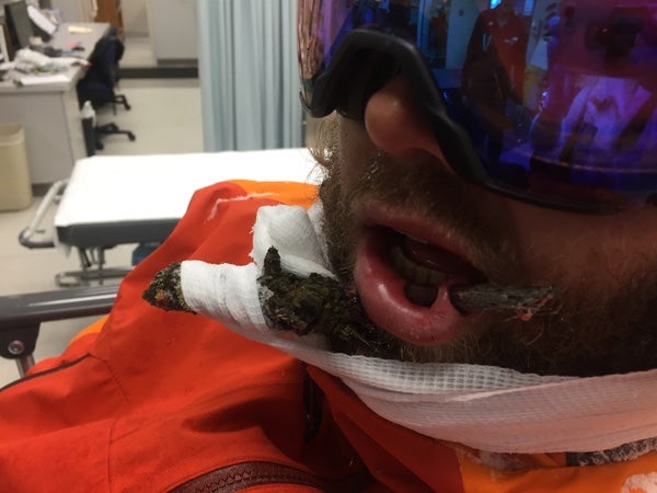 Skier takes stick to the face