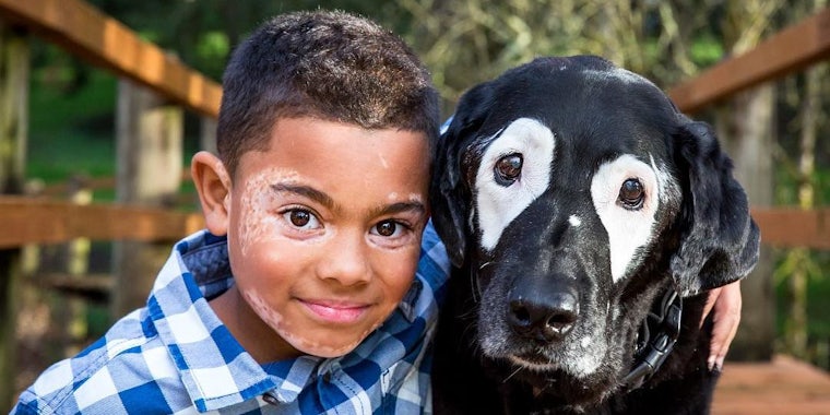 White Eyed Rowdy, a dog with vitiligo, poses with 8-year-old Carter, who has the same condition.