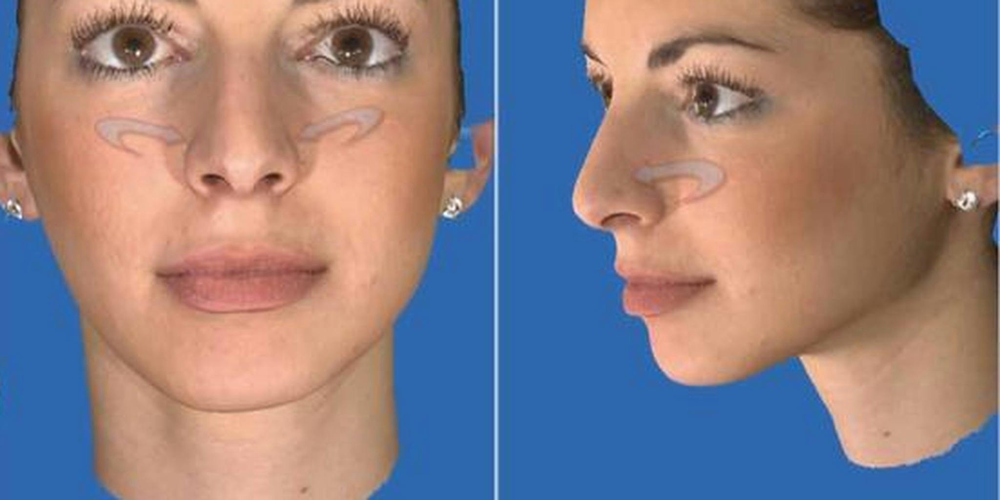 Virtual Nose Job App / Facetouchup Nose Job Simulator Apps On Google